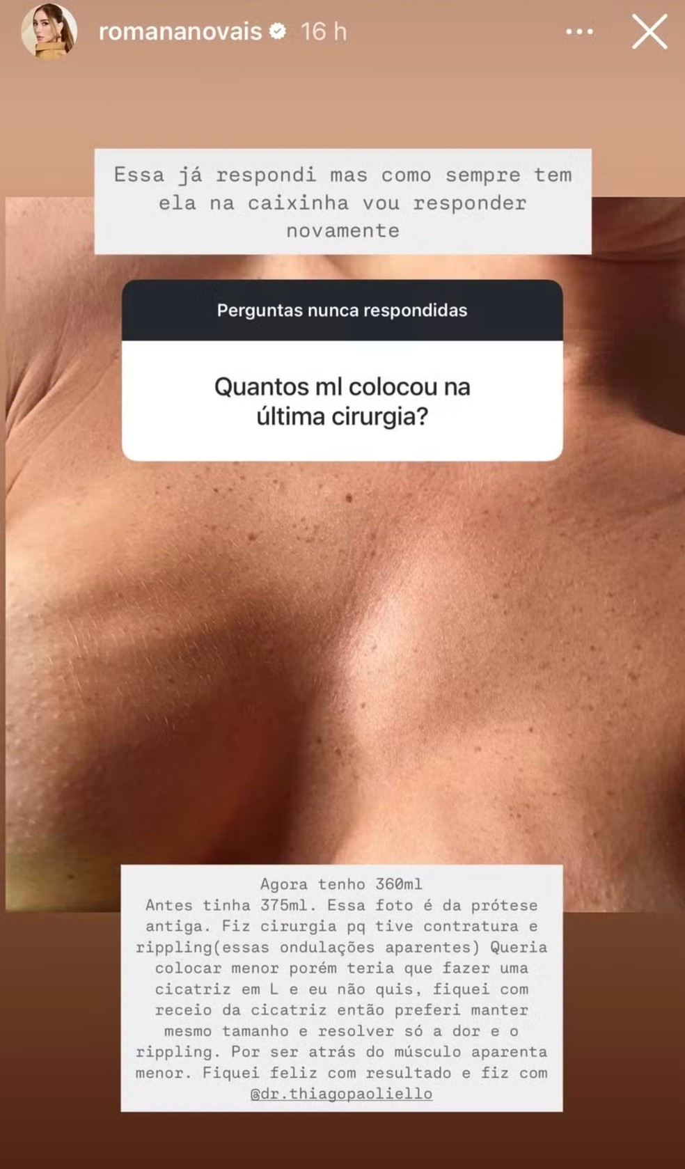 Romana Novais revelou contratura capsular em prótese de silicone — Foto: Reprodução Instagram