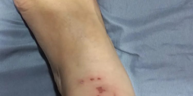 Allana Barboza mostro o tornozelo ferido depois de briga no metrô — Foto: Reprodução/Instagram