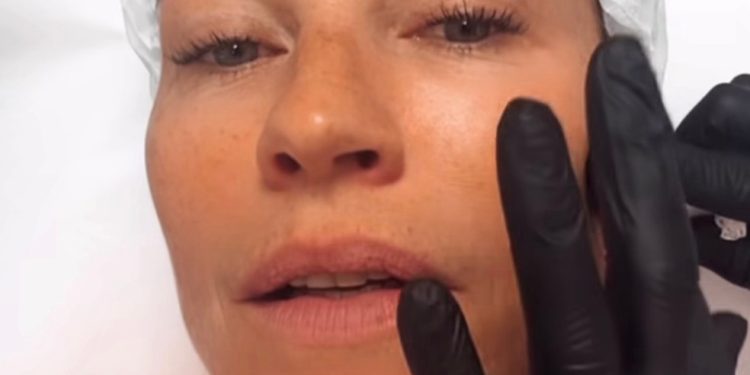 Luana Piovani fez preenchimento facial no Brasil e falou sobre marcas de expressão — Foto: Reprodução Instagram