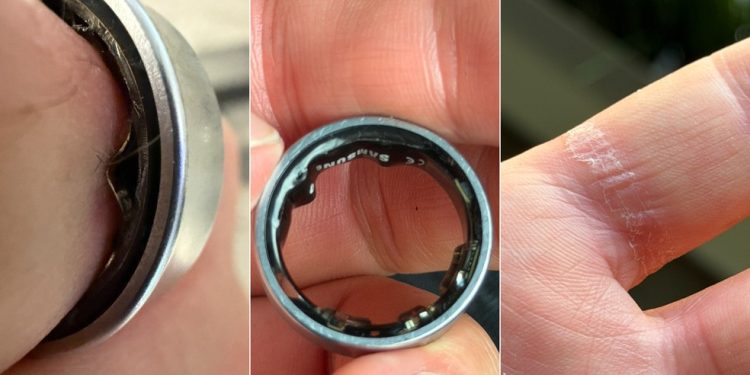 'Nunca mais vou usar': Youtuber é barrado em vôo e vai parar em hospital para remover 'anel inteligente' quebrado — Foto: Reprodução: X (@ZONEofTECH)