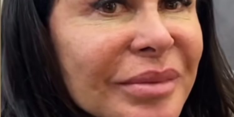 Gretchen enfrenta alopecia e compartilha tratamento — Foto: Reprodução Instagram