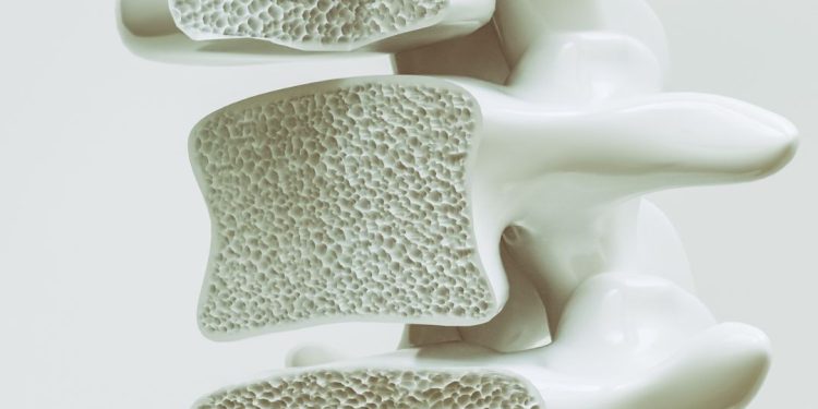 Saiba como reduzir riscos de osteoporose, segundo especialistas