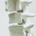 Saiba como reduzir riscos de osteoporose, segundo especialistas