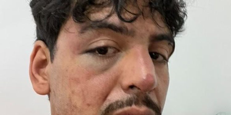 O músico Ivo Silva de Souza após sofrer agressão em janeiro — Foto: Arquivo pessoal
