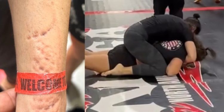Lutadora mostra marcas de mordida no antebraço após luta e critica adversária: 'Adoro dar lição em valentões'; vídeo
