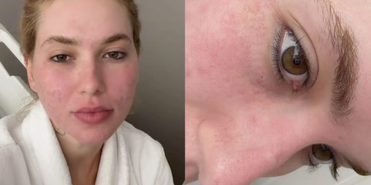 Saiba quanto pagou Virgínia Fonseca pelo tratamento estético e como ele age na pele — Foto: Reprodução Instagram