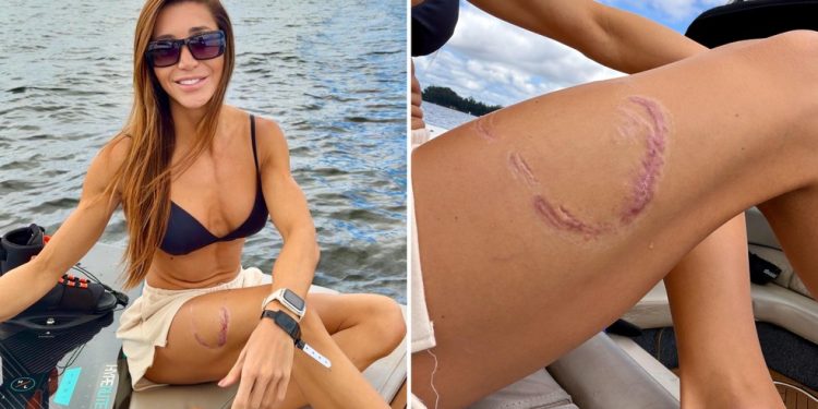 Cerca de 50 dias depois de ser mordida por um tubarão-lixa, a surfista e advogada Tayane Dalazen afirma que retornou ao mar após a cicatrização completa da lesão na perna — Foto: Reprodução/Redes sociais