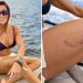 Cerca de 50 dias depois de ser mordida por um tubarão-lixa, a surfista e advogada Tayane Dalazen afirma que retornou ao mar após a cicatrização completa da lesão na perna — Foto: Reprodução/Redes sociais