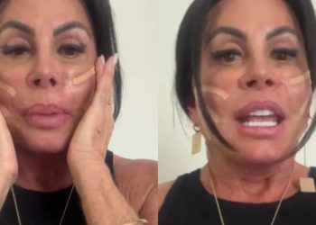 Gretchen passa por procedimento no rosto e reacende debate sobre fios de sustentação