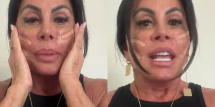 Gretchen passa por procedimento no rosto e reacende debate sobre fios de sustentação