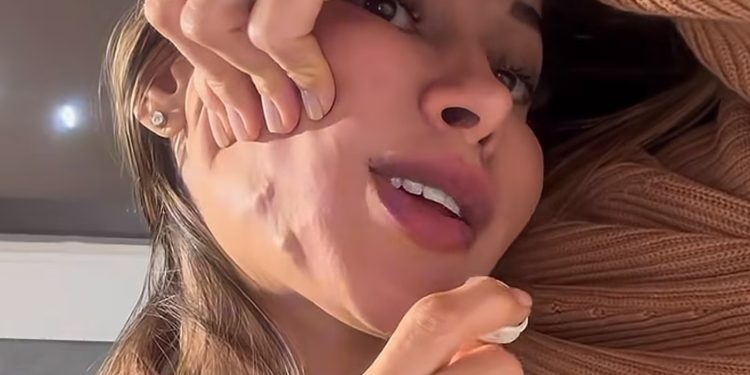 Maíra Cardi relata ter reação ao PMMA no rosto 20 anos após aplicação do produto; veja os riscos