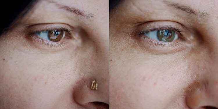 Médico desenvolve procedimento que pode mudar a cor dos olhos; entenda como funciona e quais são os riscos