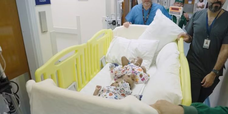 Um a cada 10 milhões: entenda cirurgia que separou gêmeas siamesas unidas pela cabeça e envolveu médicos do Brasil e de outros três países — Foto: Reprodução
