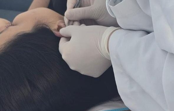 A acupuntura auricular pode ajudar a aliviar enxaquecas, afirma a neurociência