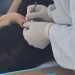 A acupuntura auricular pode ajudar a aliviar enxaquecas, afirma a neurociência