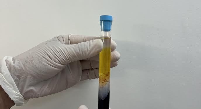CFM regulamenta PRP em condições osteomusculares
