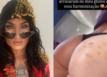 Harmonização glútea e contorno corporal: a técnica usada por ex-BBB Serginho