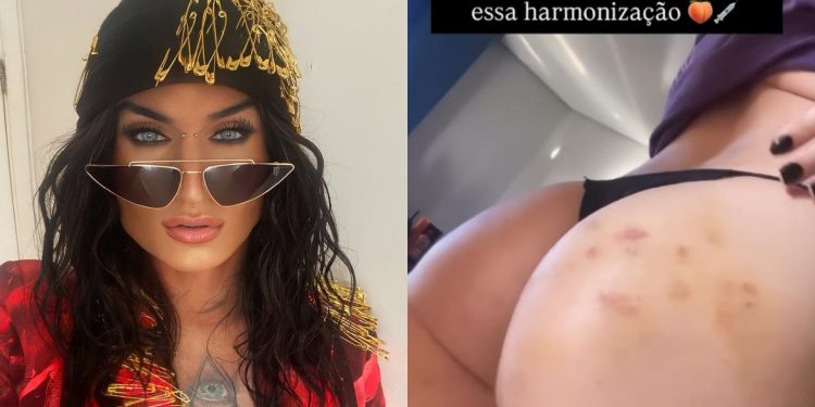 Harmonização glútea e contorno corporal: a técnica usada por ex-BBB Serginho