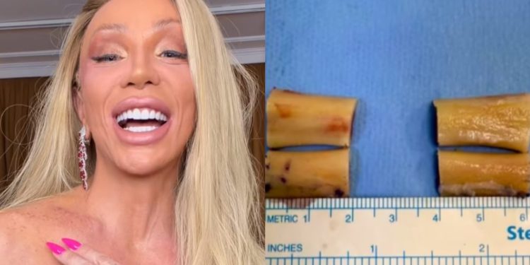 Maya Massafera mostra resultado da cirurgia para reduzir os ombros e exibe ossos removidos