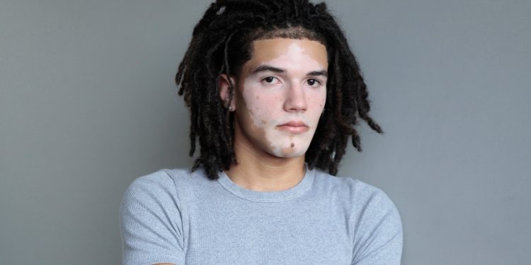 Conheça o jovem com vitiligo que estreia como modelo e quer ampliar referências de beleza