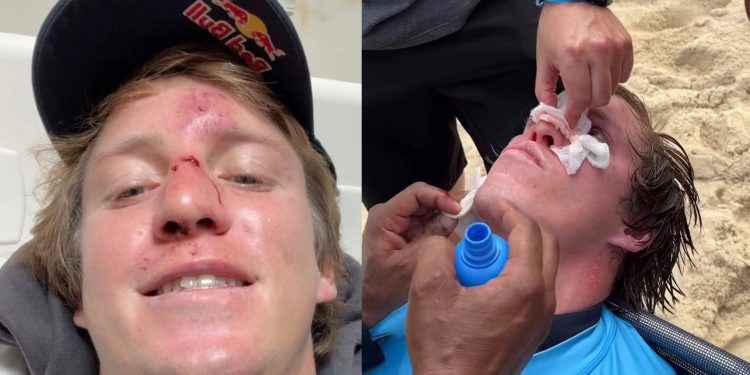 Do hospital ao pódio: Lucas Fink sofre acidente antes da final, compete com nariz fraturado e é vice no Gigantes de Nazaré