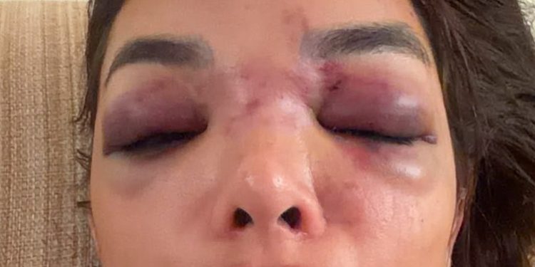 Empresário da Faria Lima é preso em flagrante por agredir mulher: ‘Deixou meu rosto deformado’