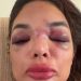 Empresário da Faria Lima é preso em flagrante por agredir mulher: ‘Deixou meu rosto deformado’