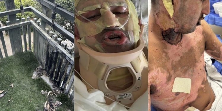 Homem processa Amazon após sofrer queimaduras de 3º grau com lareira de mesa nos EUA