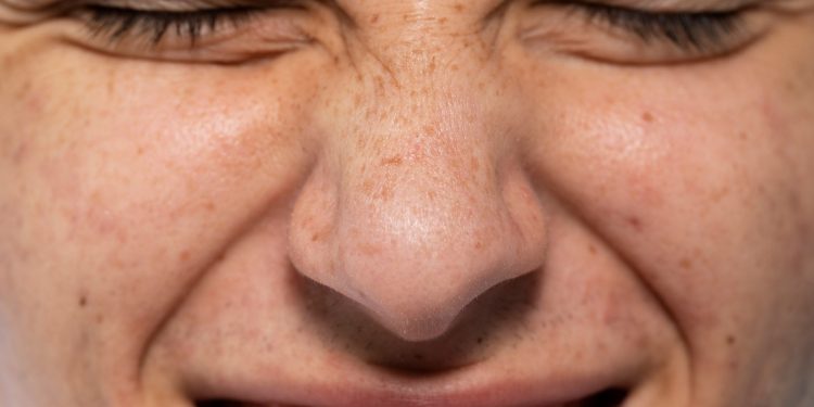 Melasma não é só culpa do sol: o que pode piorar as manchas