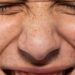 Melasma não é só culpa do sol: o que pode piorar as manchas
