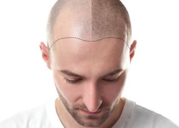Micropigmentação: Japão usa o procedimento para tatuar couro cabeludo em pessoas calvas; entenda