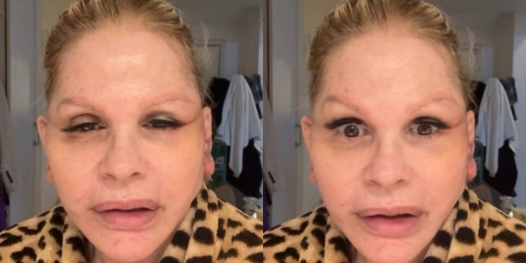 O que acontece com o rosto após uma cirurgia facial? Caso de Monique Evans ajuda a explicar o processo