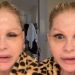 O que acontece com o rosto após uma cirurgia facial? Caso de Monique Evans ajuda a explicar o processo