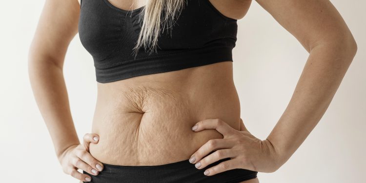 Perdeu peso com as canetas emagrecedoras? Veja como cuidar da flacidez da pele