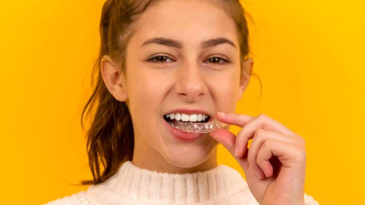 Alinhador invisível: como funciona o tratamento dentário