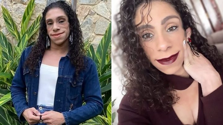 Mulher tem ausência quase total de gordura aparente causada por doença rara; entenda