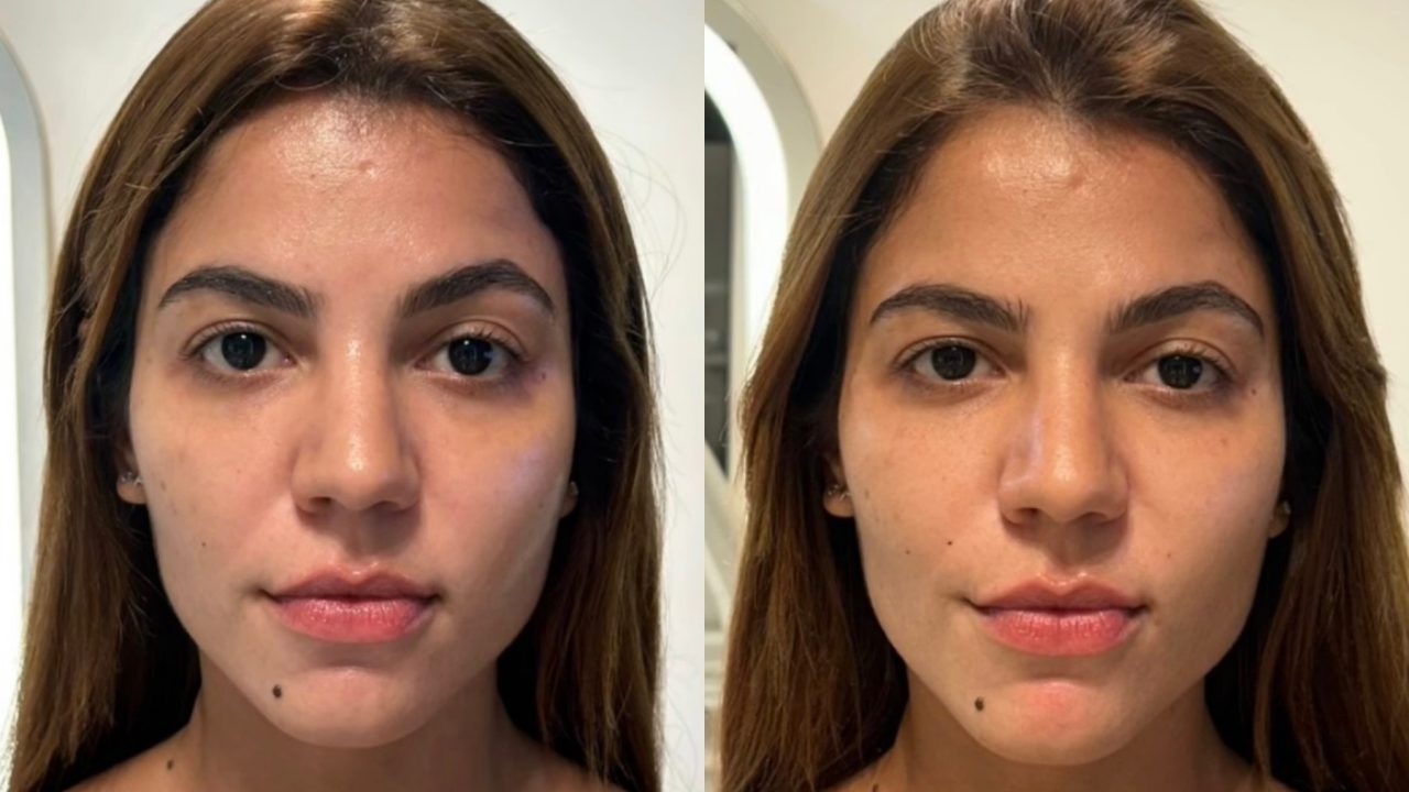 O que muda no rosto quando a aparência parece mais descansada? Hariany Almeida mostra o resultado
