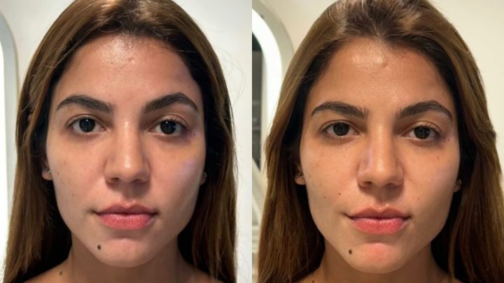 O que muda no rosto quando a aparência parece mais descansada? Hariany Almeida mostra o resultado