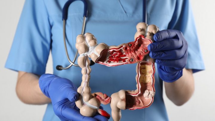 Por que o câncer de intestino está aumentando entre os jovens?