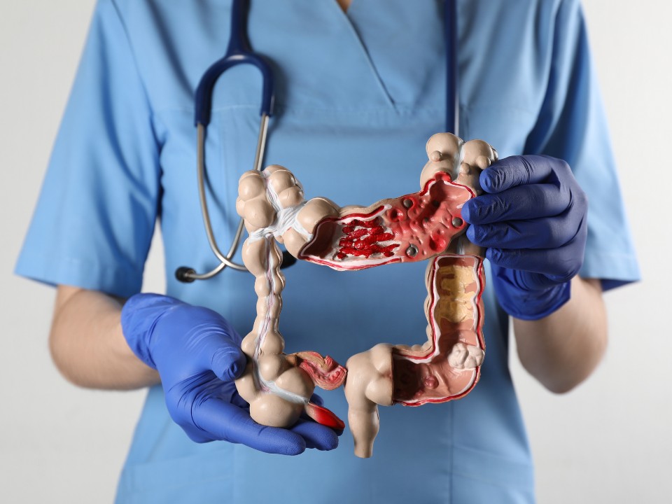Por que o câncer de intestino está aumentando entre os jovens?
