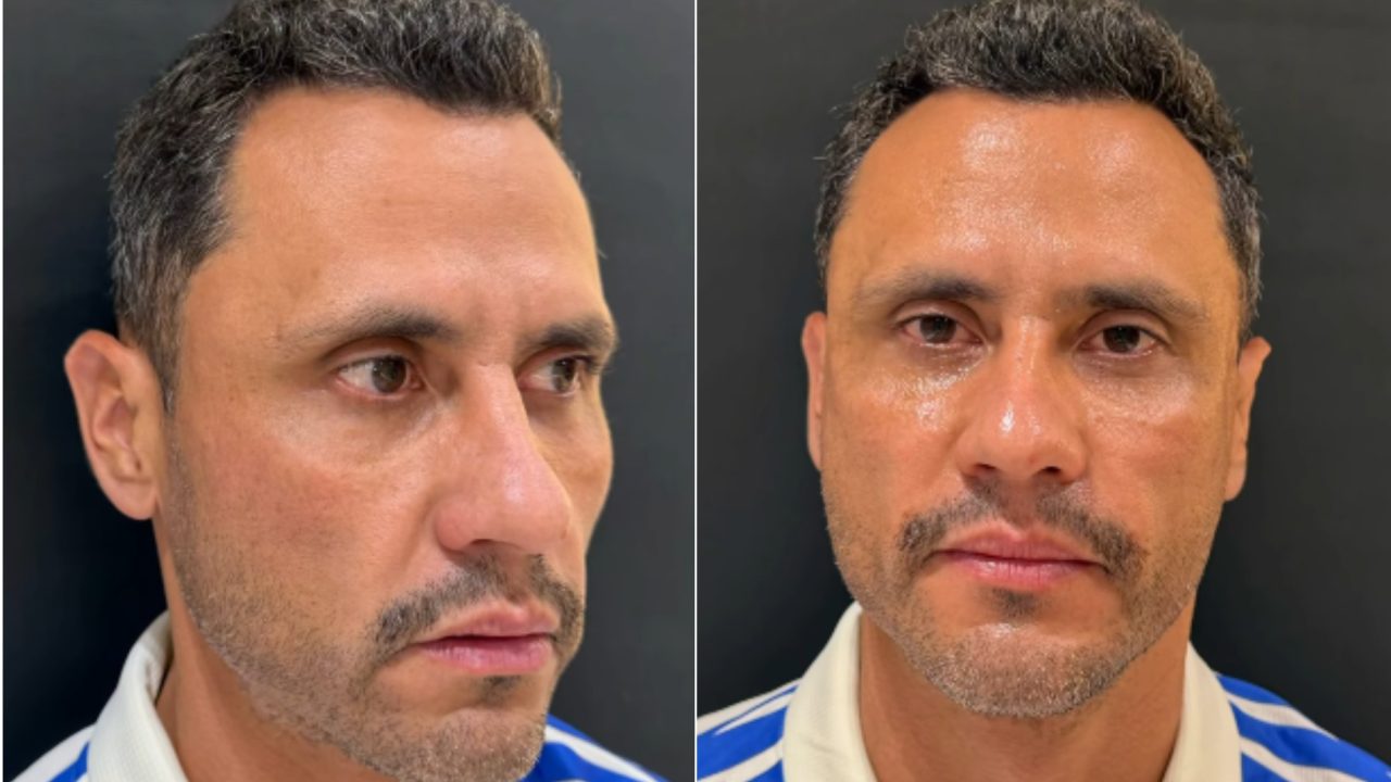 Cleitinho faz harmonização facial após ser eleito governador de Minas Gerais